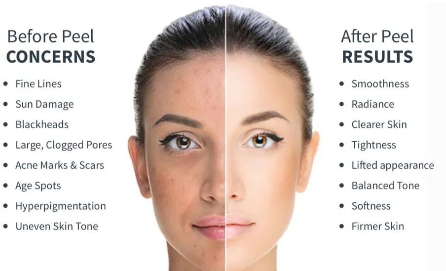 benefits of peels - Andrea Heath Aesthetics