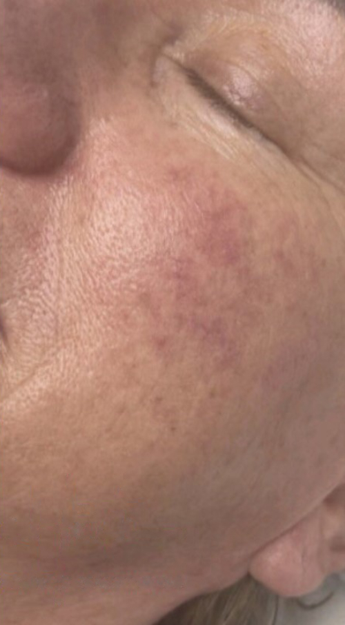 rosacea-after