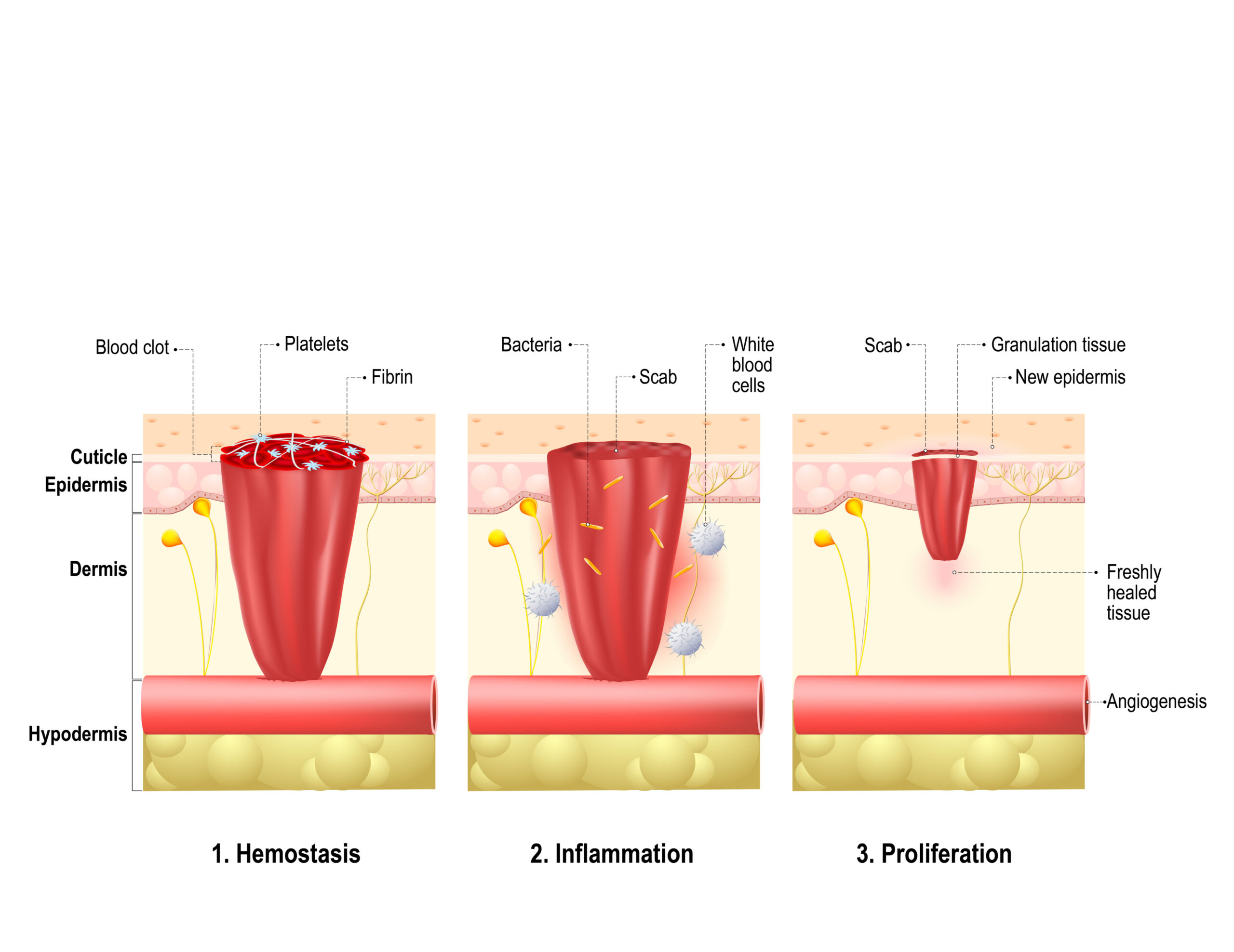 wound stages - Andrea Heath Aesthetic Treatments